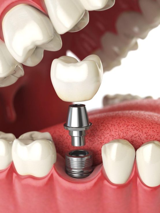 Peut-on poser un implant dentaire en une journée?