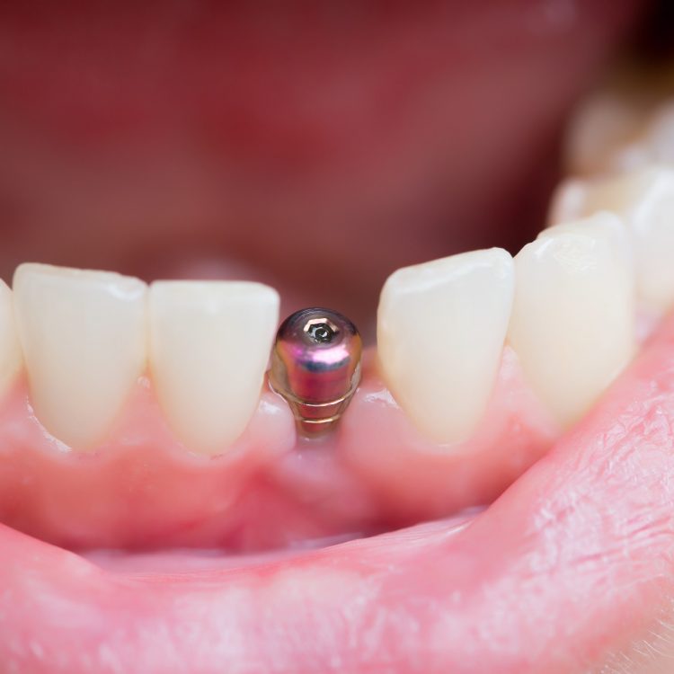 Avantages des implants dentaires à une