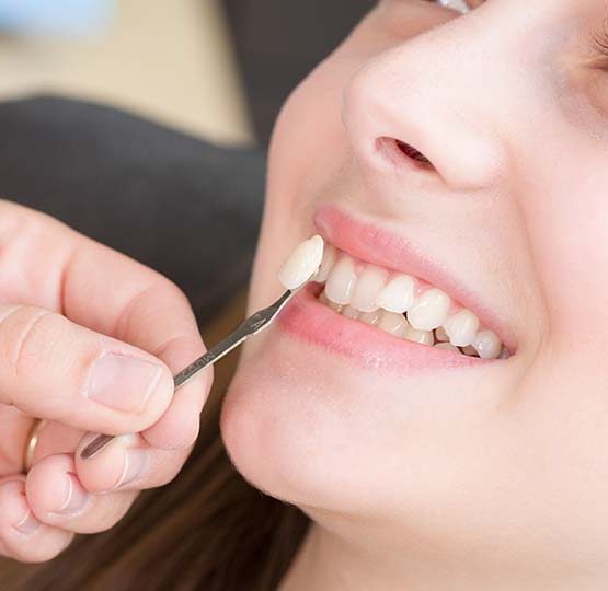 Dans quels types de situations le placement d'une facette dentaire E-Max est-il préférable?