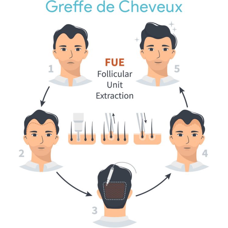 greffe de cheveux Fue