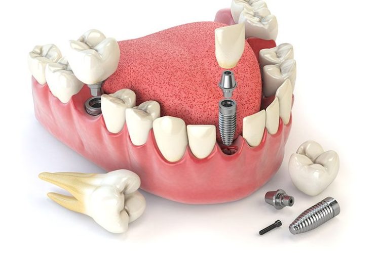 Qui Peut Bénéficier de la Pose de L'implant Dentaire?