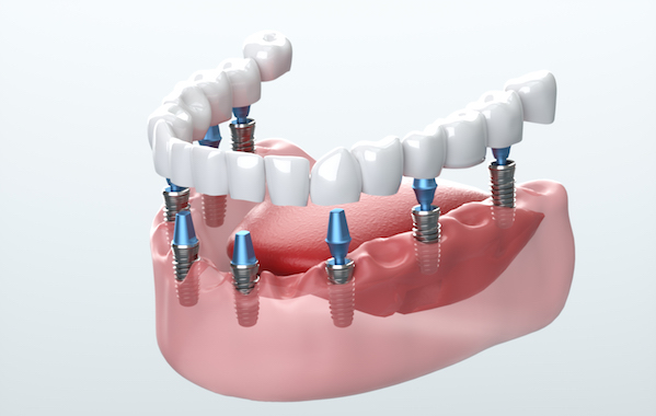 Comment le nombre d'implants est-il déterminé?