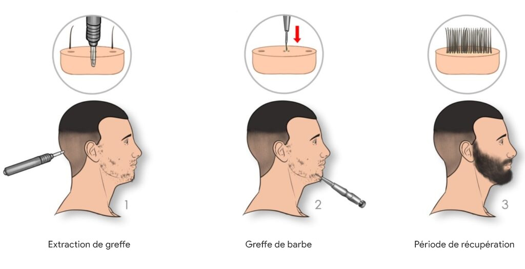 Processus de greffe de barbe