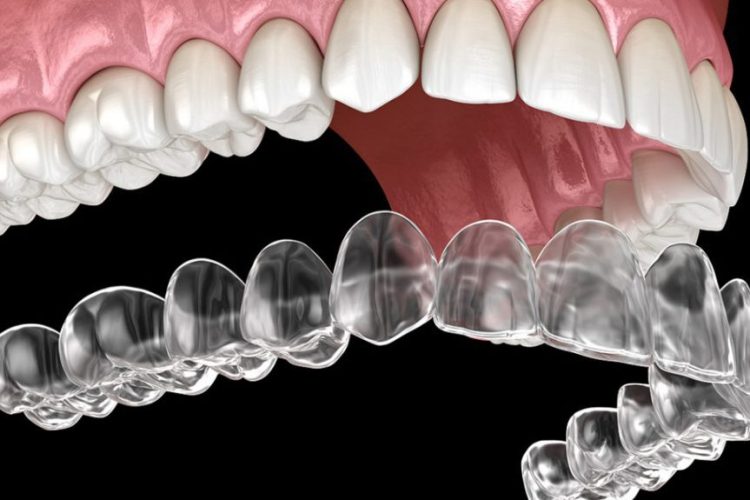 traitement-invisalign3