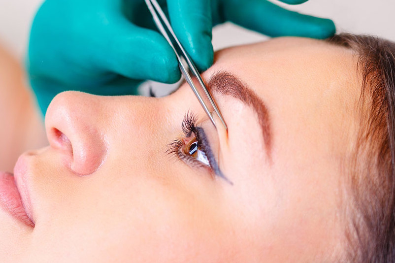 blepharoplastie