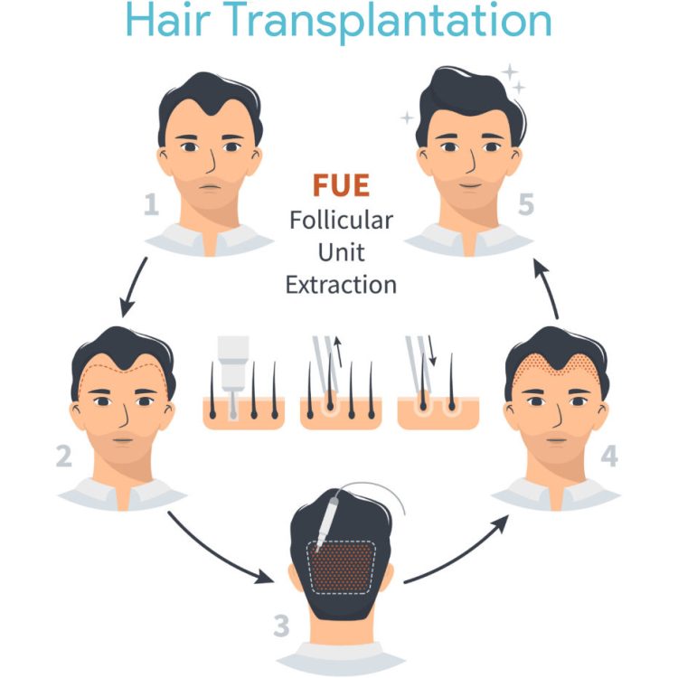 Fue Hair Transplantation