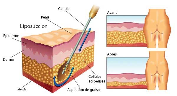 Qui Peut Subir Une Chirurgie de Liposuccion?