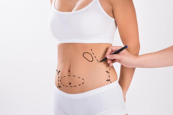 Pourquoi Faire Des Abdominoplasties?