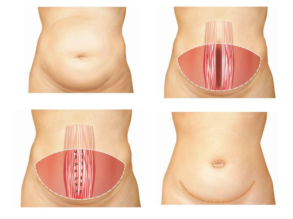 Qu'est-ce que Abdominoplasties?